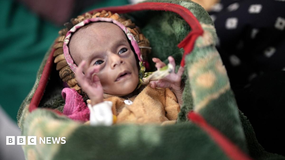 New child twins battle for survival as battle fuels Yemen’s starvation disaster